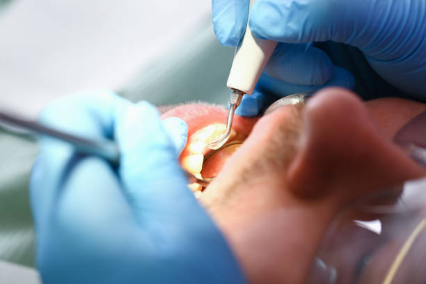 Best Emergency Root Canal Treatment in Tarpon Springs, FL